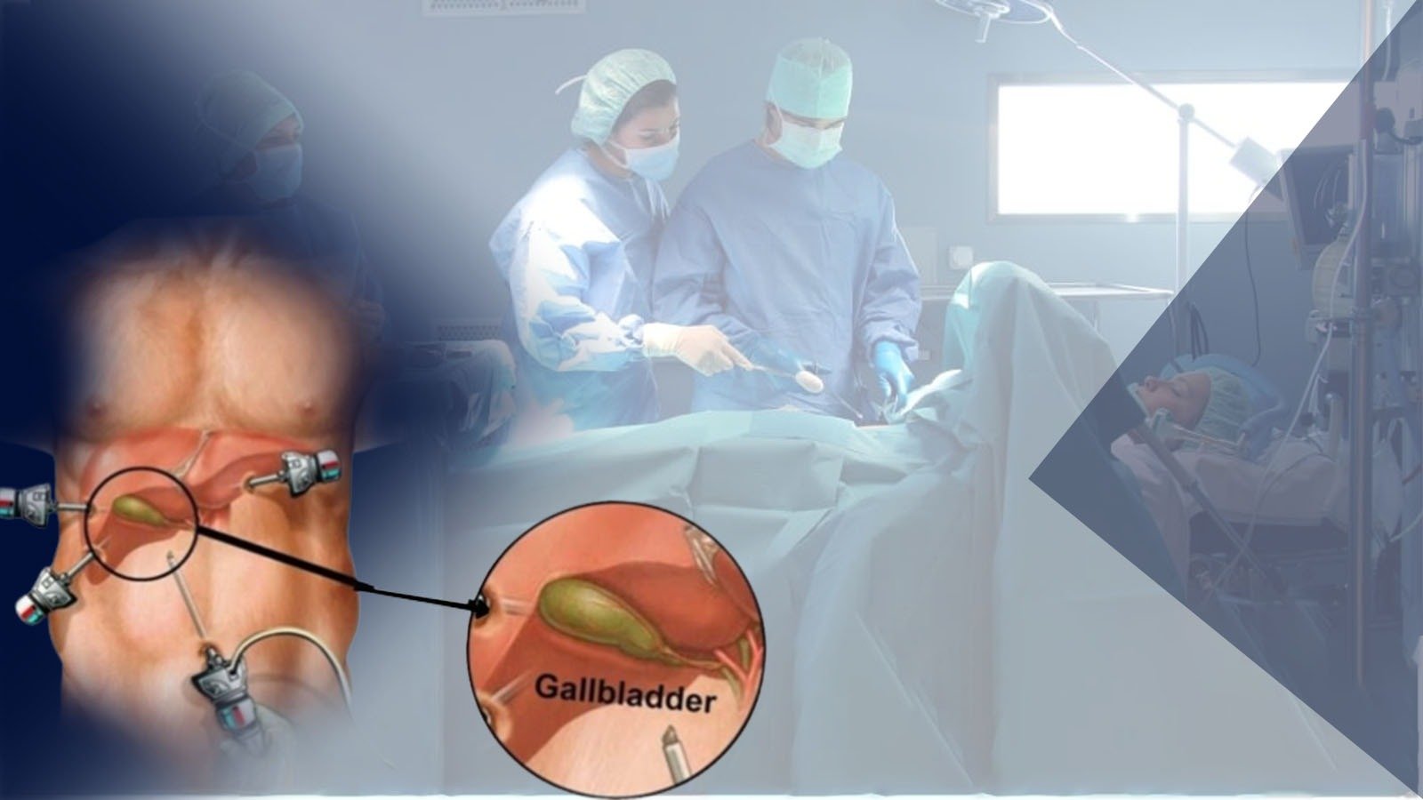 You are currently viewing Best Laparoscopic Cholecystectomy Surgeon Kolkata