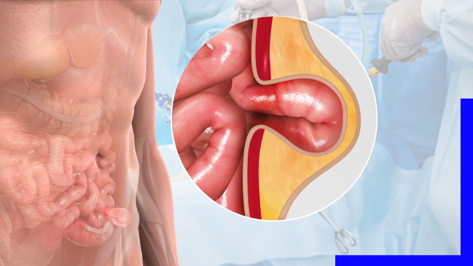 You are currently viewing Best Laparoscopic Hernia Surgeon in Kolkata