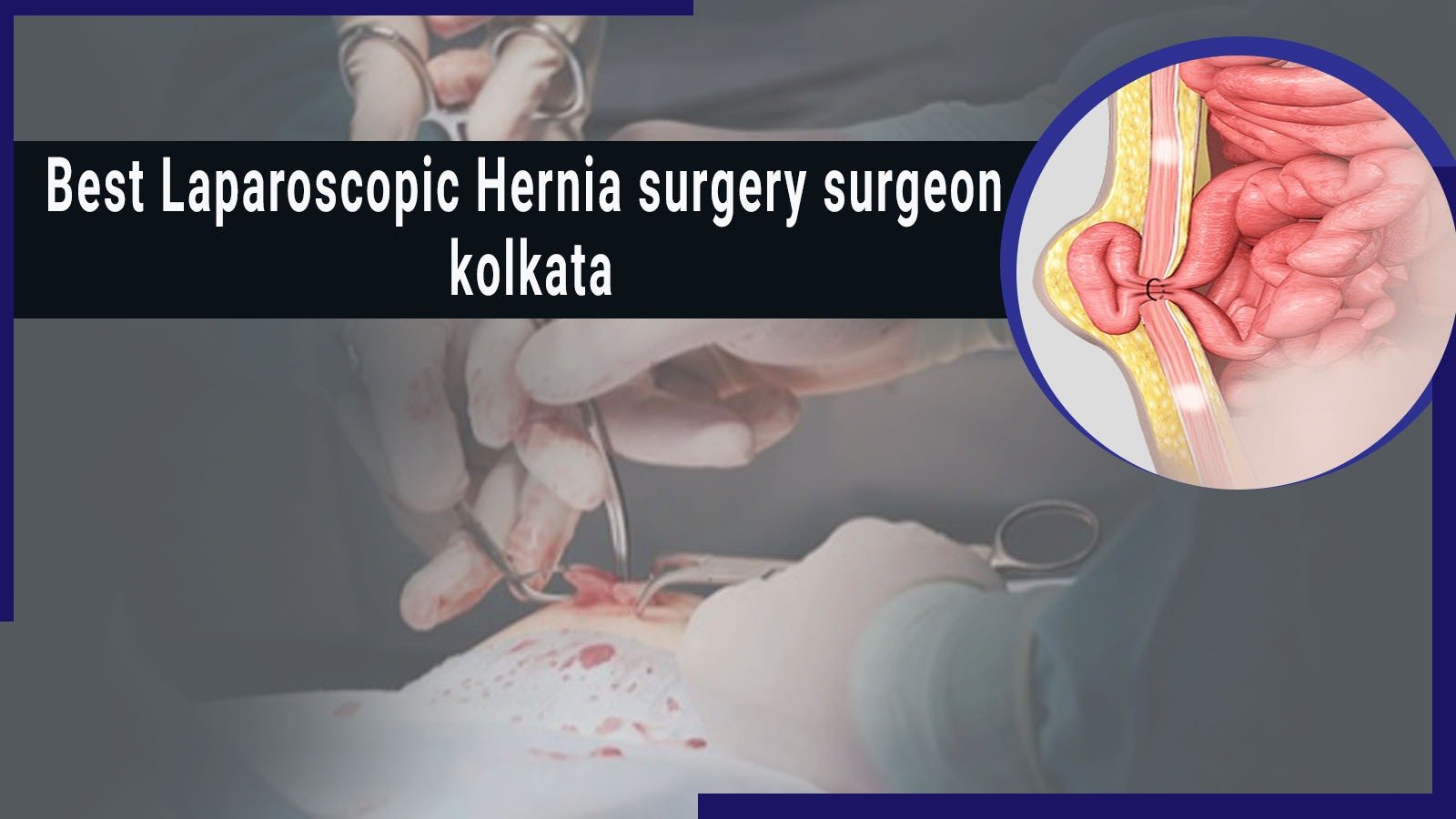 You are currently viewing Best Laparoscopic Hernia Surgery Surgeon Kolkata